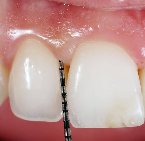 Clínica Dental Águila en Quito ¿Por qué me sangran las encías cuando me cepillo?