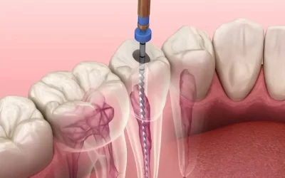 endodoncia-unirradicular